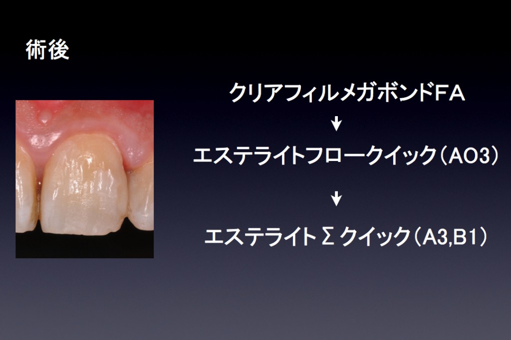 象牙質　接着.002